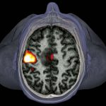 Brain imaging network analysis